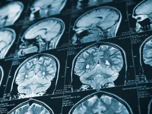 The Alarming Link Between Head Injuries And Serial Killers