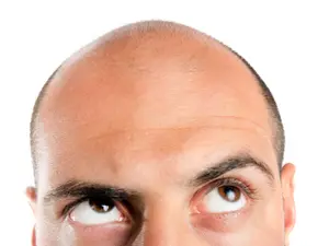 The Real Reasons Men Go Bald And What You Can Do About It